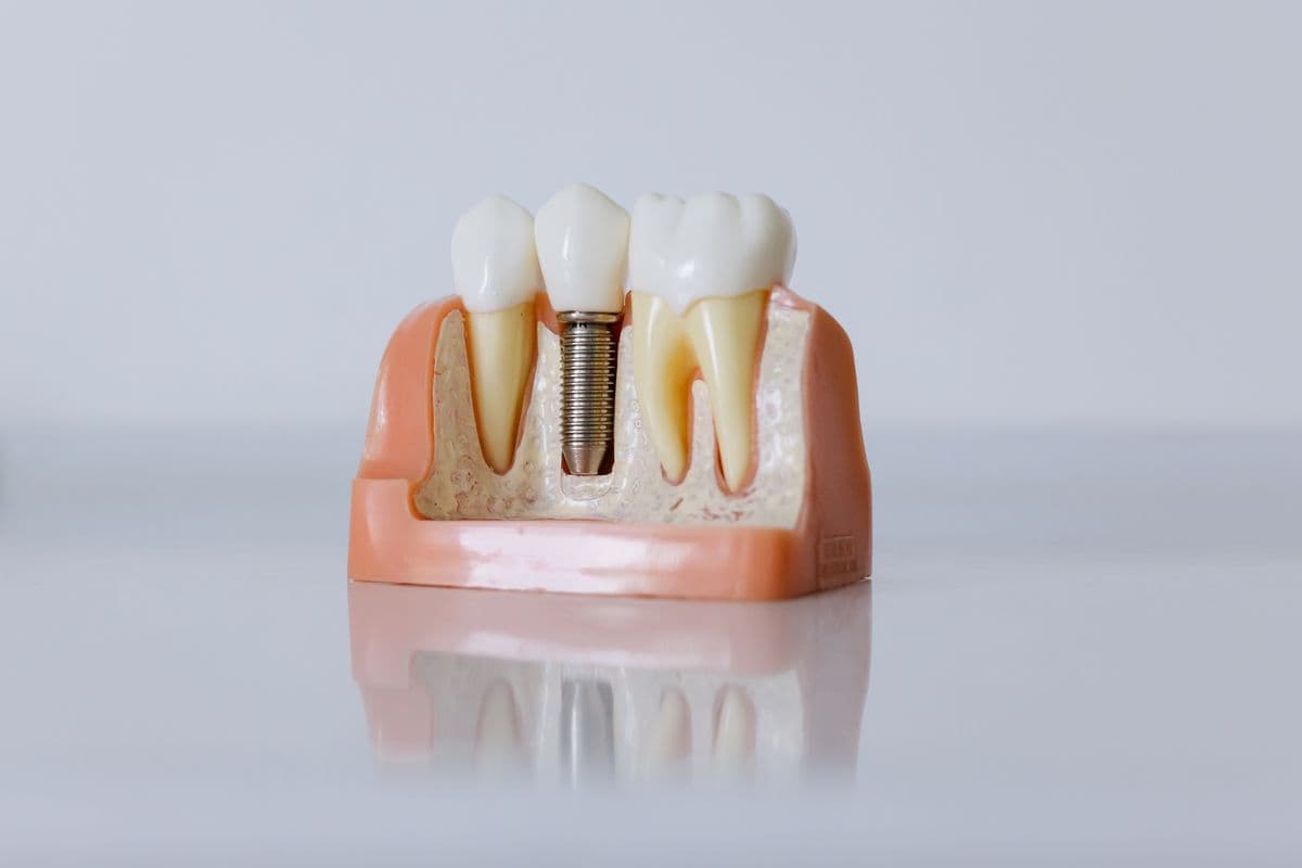 Dental Implants at Care Plus Dental Clinic